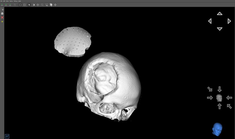 Screenshot aus der App mit einem 3D-Implantatmodell, welches von Herrn Patrick Knorr konstruiert wurde.