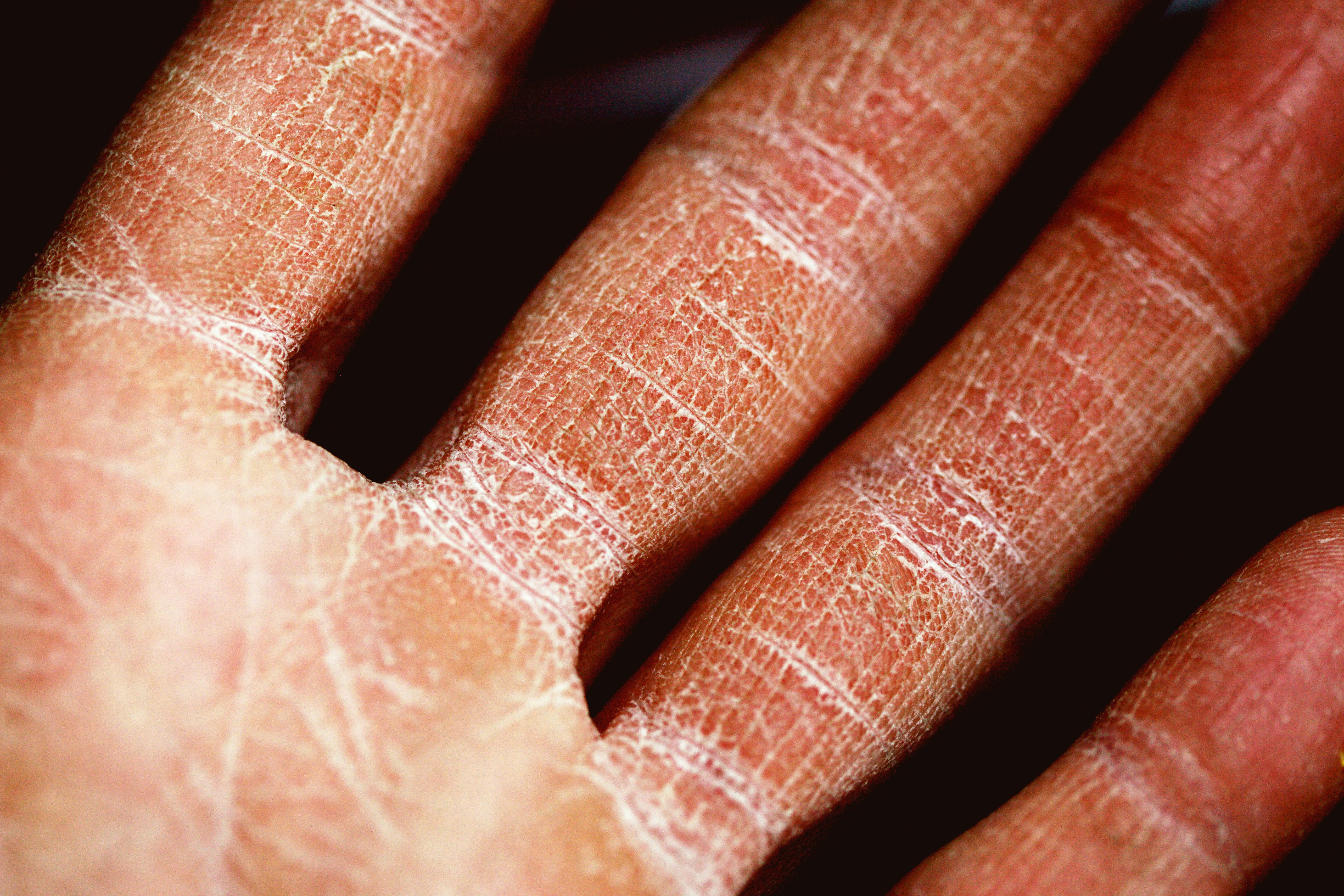 Hand mit weißem Belag, Trockene Haut